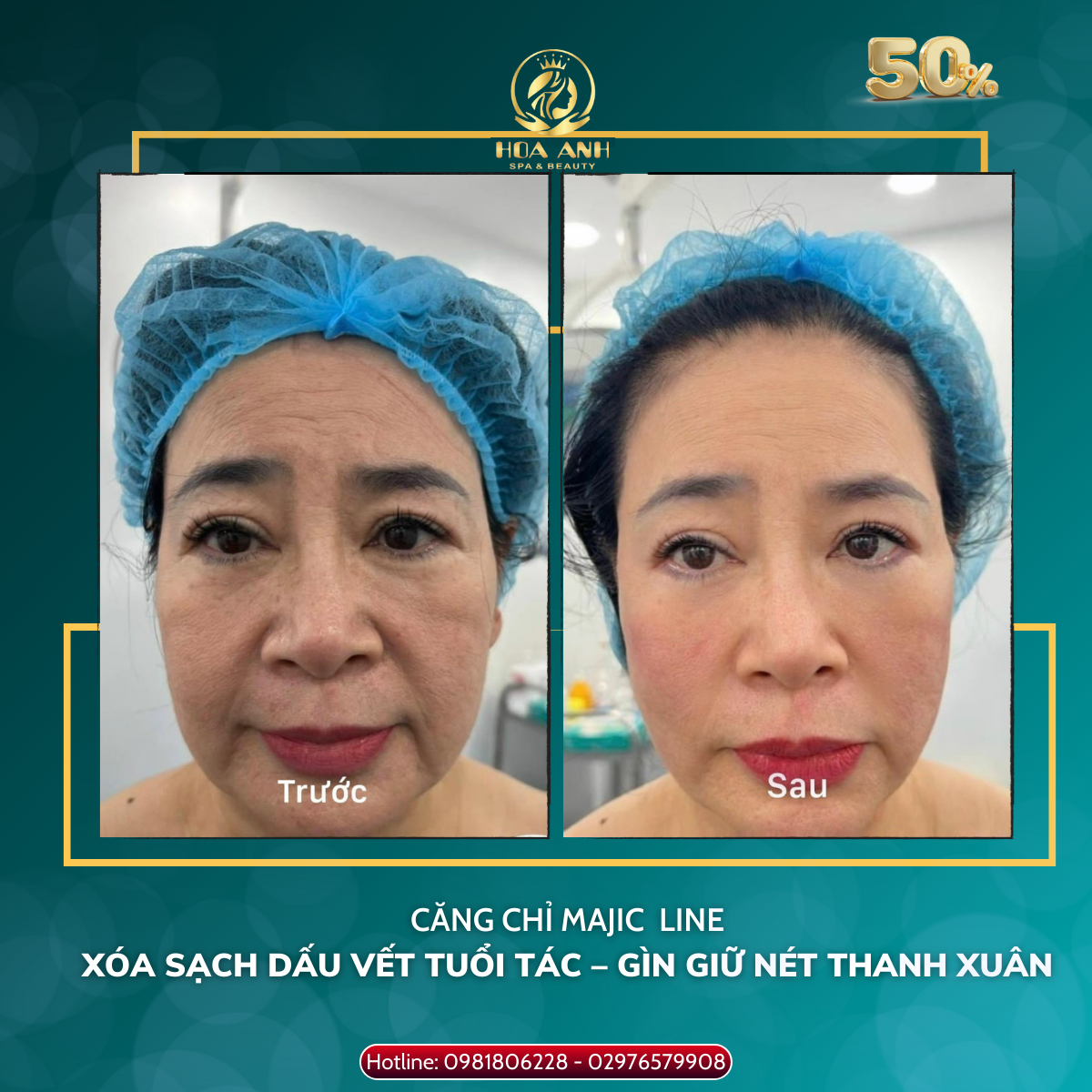 CÁC PHƯƠNG PHÁP XÓA NHĂN HIỆU QUẢ